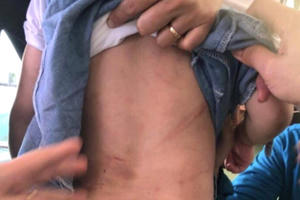 Biếng ăn, bé 3 tuổi bị dì ruột dùng móc áo, cán chổi lau nhà đánh gây thương tích