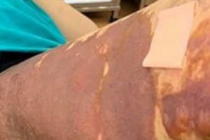 Thêm nạn nhân của Thẩm mỹ viện Việt Hàn bỏng nặng sau hút mỡ