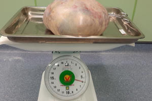 Phẫu thuật bóc tách khối u nặng gần 6kg ra khỏi cơ thể người phụ nữ Phẫu thuật bóc tách khối u nặng gần 6kg ra khỏi cơ thể người phụ nữ