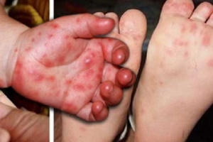 Đã có đủ thuốc điều trị bệnh tay chân miệng