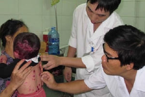 Thủy đậu vào mùa, trẻ em và phụ nữ có thai cần cẩn thận Thủy đậu vào mùa, trẻ em và phụ nữ có thai cần cẩn thận