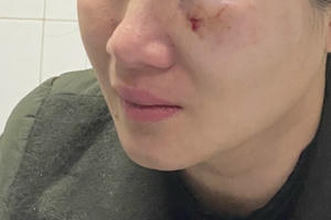 Người phụ nữ bị hành hung gây tổn hại sức khoẻ 16%: Vì sao TAND huyện Ứng Hoà lại cho các đối tượng hưởng án treo?