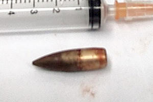 Nghệ An: Cứu sống thần kỳ nam bệnh nhân bị đạn xuyên thủng tim khi đốt rác