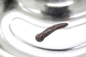 Đỉa trâu dài 10 cm sống nhiều ngày trong cổ họng bệnh nhân