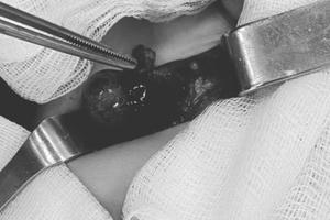 Hà Nội: Cắt tinh hoàn bị xoắn hoại tử cho bệnh nhi 10 tháng tuổi