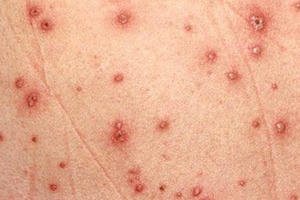 Bác sĩ Nhi khoa lưu ý cách điều trị thủy đậu cho trẻ đúng cách Bác sĩ Nhi khoa lưu ý cách điều trị thủy đậu cho trẻ đúng cách