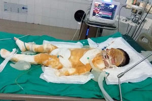 Xót xa cảnh bé 4 tuổi toàn thân quấn bông băng nằm trên giường bệnh