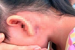 Cứu sống trẻ bị nhiễm vi khuẩn ăn thịt người