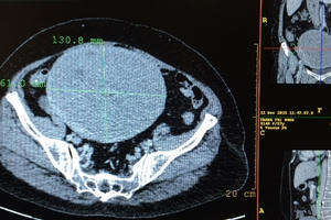 Phẫu thuật thành công khối u tử cung có kích thước lớn như quả bưởi