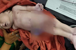 Bé trai 'người cá' chào đời ở Ấn Độ