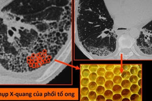 Virus corona mới tàn phá các bộ phận trên cơ thể như thế nào?