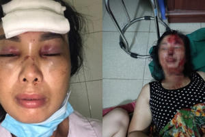 Người phụ nữ 44 tuổi tại Hải Dương tố cáo bị chồng chích điện, dìm xuống nước phải nhập viện cấp cứu