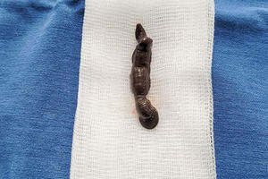 Cháu bé tắm suối, bị đỉa dài 4cm chui vào khí quản