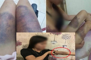 Cô gái trẻ tố bị bạn trai hành hung bầm dập khắp người