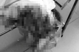 Nam Định: Thiếu niên nát nhừ bàn tay vì điện thoại phát nổ