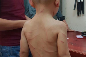 Khởi tố, bắt tạm giam cha dượng bạo hành dã man bé trai 3 tuổi