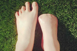 Người phụ nữ phải cắt bỏ 5 ngón chân vì để cá rỉa trong spa