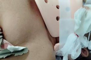 Kinh hoàng người đàn ông ngã từ cây nhãn bị thanh thép đâm xuyên từ nách qua cổ lên đến đỉnh đầu