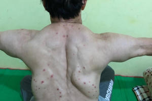 Choáng với khối u mọc chi chít trên người bệnh nhân nghi do uống nhiều rượu