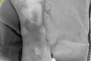 Kịp thời cứu chữa 03 trẻ bị bỏng nặng do gia đình bất cẩn khi ăn lẩu