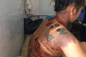 Thanh Hóa: Giận nhau, chồng đổ cả ấm nước sôi lên người vợ