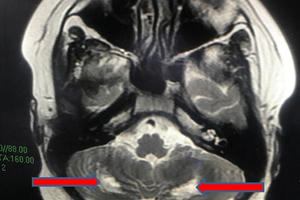 TP HCM: Hậu COVID-19, trẻ 13 tuổi bị viêm đa hệ thống tổn thương não