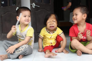 Cô gái 30 tuổi mang hình hài đứa trẻ lên 3