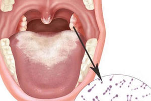 Đã có 20 trường hợp mắc bạch hầu, Bộ Y tế yêu cầu tăng cường phòng, chống