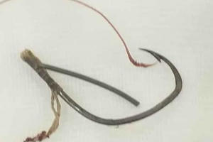 Người đàn ông được đưa đến bệnh viện với chiếc lưỡi câu móc thẳng vào mắt