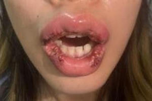 Môi biến dạng, viêm nhiễm sau phẫu thuật hình trái tim Môi biến dạng, viêm nhiễm sau phẫu thuật hình trái tim