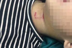 Nghệ An: Bé 3 tuổi bị chó hàng xóm tấn công, cắn rách phần cổ, thủng khí quản