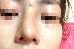 Vụ bé gái 13 tuổi tổn hại 42% sức khỏe khi đi nâng mũi: Có dấu hiệu bao che tội phạm? Vụ bé gái 13 tuổi tổn hại 42% sức khỏe khi đi nâng mũi: Có dấu hiệu bao che tội phạm?