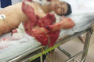 Xích mích nhỏ, một thanh niên bị chém đứt lìa cánh tay