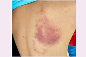 Cô giáo đánh học sinh bầm lưng ở Hải Phòng bị phạt 5 triệu đồng