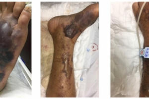 Cảnh báo 'vi khuẩn ăn thịt người' từ biển