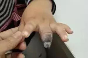 Dán urgo sai cách, bé gái 4 tuổi phải cắt bỏ 2 đốt ngón tay