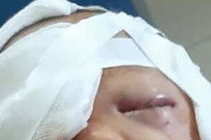 Thái Nguyên: Cháu bé bị chó nhà cắn rách đầu, mặt