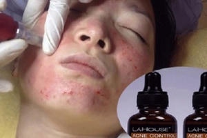 Đình chỉ lưu hành mỹ phẩm Acne control serum trị mụn