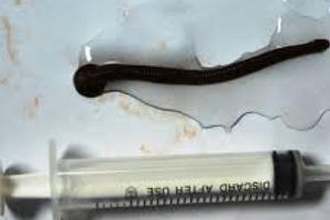 Lạ kỳ con đỉa sống 3 tháng trong mũi người đàn ông