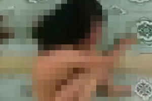 Nữ sinh phải nhập viện vì bị lột đồ, đánh hội đồng dã man đã bị đánh rất nhiều lần