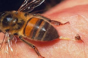 Bé gái 18 tháng tuổi bị ong đốt gần 50 nốt