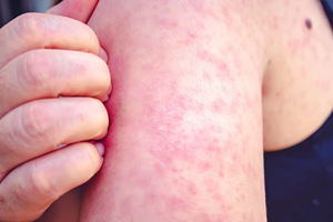 Bệnh sởi, ho gà đang có diễn biến phức tạp