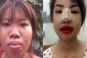 Mẹ đơn thân kể chuyện phẫu thuật thẩm mỹ vì quá xấu