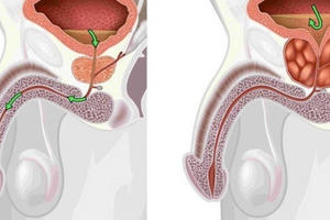 Bệnh viện Hữu nghị Việt Đức khám miễn phí về bệnh sỏi tiết niệu và u tuyến tiền liệt