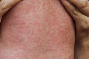 Ca mắc sởi ở Đồng Nai đang giảm mạnh