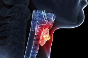 Phát hiện u tuyến giáp lành tính có cần phẫu thuật?