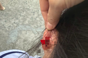 Phú Quốc: Xem xét kỷ luật giáo viên lớp 1 bị tố nhéo tai học sinh đến chảy máu