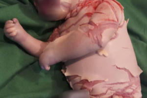 Bé sơ sinh ở Lào Cai mắc bệnh vảy cá hiếm gặp