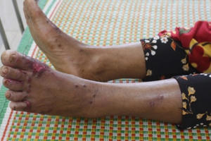 Một bệnh nhân viêm da dày sừng đã tử vong