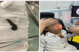 Gắp khỏi mũi xoang 2 bệnh nhi dị vật giống con đỉa dài gần 7cm